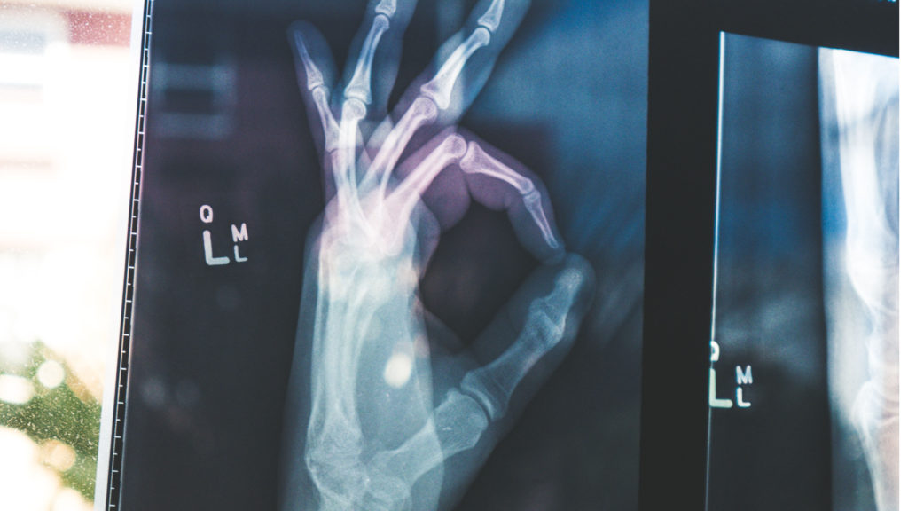 Hand röntgen
